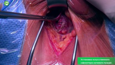 Установка искусственного сфинктера мочевого пузыря