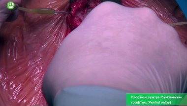 Пластика уретры буккальным графтом (Ventral onlay)