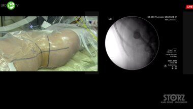 Мартов А.Г. - Мини-перкутанная лазерная нефролитотрипсия