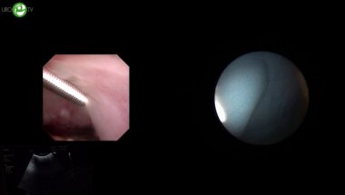 Сорокин Н.И., Акопян Г.Н. - Эндоскопическая комбинированная интраренальная хирургия (ECIRS)