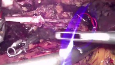 Галлямов Э.А. - Уникальная операция удаления тромба из нижней полой вены