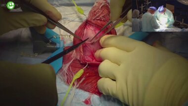 Топузов Т.М. - Фаллопротезирование однокомпонентным протезом Genesis