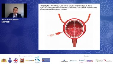 Миркин Я.Б. - Интерстициальный цистит или синдром болезненного мочевого пузыря