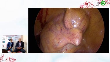 Шкодкин С.В. - Лапароскопическая кольпосуспензия по Burch