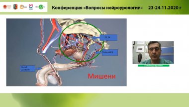 Касян Г.Р. - Сакральная нейромодуляция при идиопатических формах нарушения акта мочеиспускания