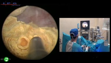Дымов А.М. - Цистолитотрипсия на высокой мощности с последующей энуклеацией гиперплазии предстательной железы