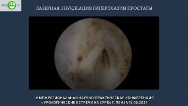 Дымов А.М. - Лазерная Энуклеация гиперплазии простаты