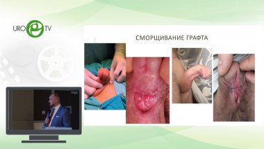 Котов С.В. - Новый подход в многоэтапной уретропластике