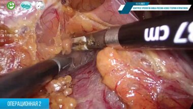 Амоев З.В. - Резекция правой почки