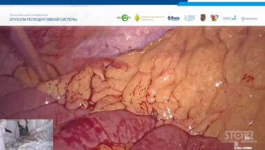 Котов С.В. - Трансляция из операционной ГБУЗ ЯО Областная клиническая онкологическая больница. Радикальная лапароскопическая простатэктомия