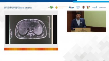 Холтобин Д.П. - Лапароскопическая адреналэктомия при раке надпочечника