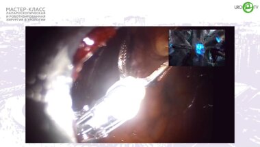 Сосновский И.Б. - Робот ассистированная радикальная простатэктомия с лимфодесекцией