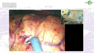 Грачёв С.В. - Робот-ассистированная адреналэктомия