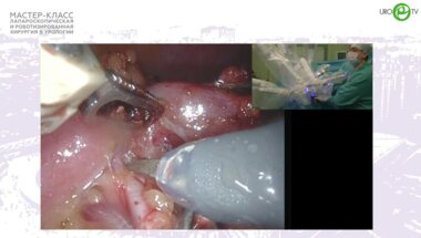 Ракул - Робот-ассистированная резекция почки R.E.N.A.L.-11