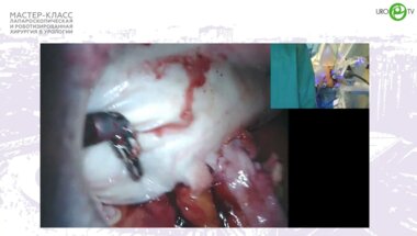 Медведев В.Л. - Робот-ассистированная чрескожная адэномэктомия