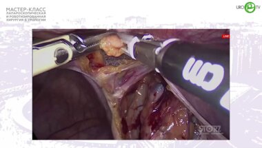 Димитриади С.Н. - Лапароскопическая радикальная простатэктомия с лимфодиссекцией