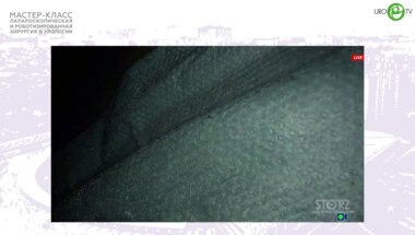 Новиков А.Б. - Лапароскопическая позадилонная аденомэктомия, с сохранением уретры