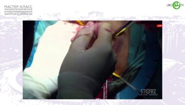 Пучков К.В. - Лапароскопическая кольпосакровагинопексия