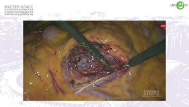Дмитренко Г.Д. - Лапароскопическая пластика ЛМС