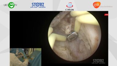 Мартов А.Г. - Биполярная энуклеация простаты