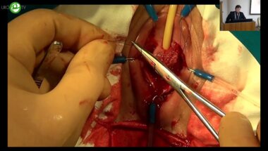 Еркович А.А. - Дистальная уретропластика ротированным влагалищным лоскутом