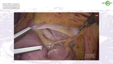 Сергеев В.П. - Лапароскопическая нефректомия тазоводистопированной почки. Лимфаденэкктомия