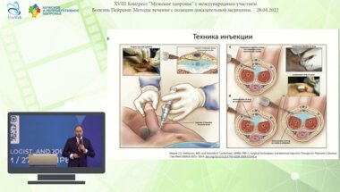 Котов С.В. - Инъекционная, тракционная и ударно-волновая терапия болезни Пейрони