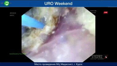 Сорокин Н.И. - Ретроградная гибкая интраренальная пиелолитотрипсия (Fiberlase U3, Innovex)