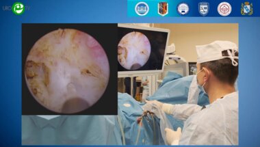 Сорокин Н.И. - Трансуретральная лазерная энуклеация аденомы простаты (видеооперация)