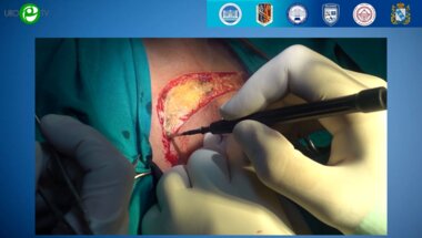 Шадури В.Р. - Промежностная аденомэктомия (видеооперция)