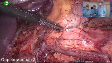 Галлямов Э.А. - Лапароскопическая 2-сторонняя резекция почек