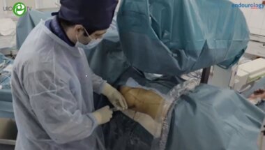 Гаджиев Н.К. - Стандарная нефролитотрипсия в положении на спине