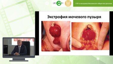 Даренков С.П., Коварский С.Л., Захаров А.И. - Коррекция удерживающего механизма континентной стомы у больных с замкнутым мочевым резервуаром