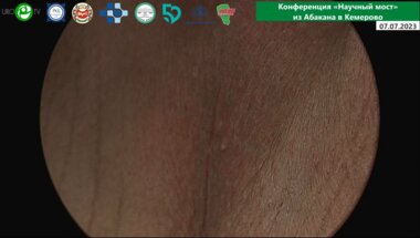 Филимонов В.Б. - Имплантация мужского слинга