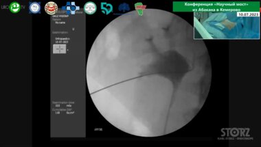 Байков Н.А. - Миниперкутанная нефролитотрипсия