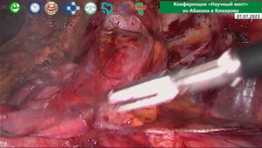 Помешкин Е.В. - Лапароскопическая резекция почки