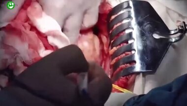 Коротков В.А. - Передняя экзентерация малого таза. Радикальная цистэктомия с формированием гетеротопического континентного резервуара