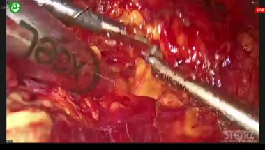 Котов С.В. - Лапароскопическая транскапсулярная аденомэктомия