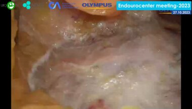 Вязовцев П.В. - Лапароскопическая резекция почки с эндоваскулярной окклюзией почечной артерии