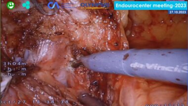 Мосоян М.С. - Робот-ассистированная нейросохраняющая радикальная простатэктомия (роботическая система da Vinci Si)