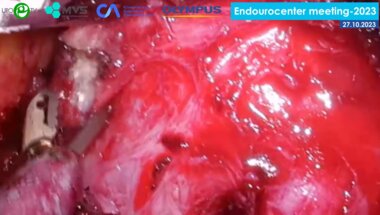 Топузов Т.М. - Ретроперитонеоскопическая аденомэктомия