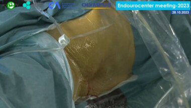 Сулейманов М.М., Пазин И.С. - Симультанная билатеральная эндоскопическая хирургия