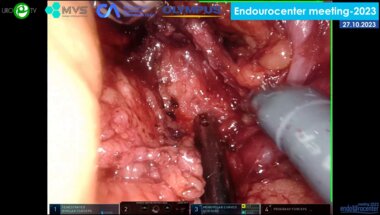 Медведев В.Л. - Робот-ассистированная резекция почки (роботическая система da Vinci Xi)