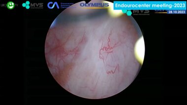 Андронов А.С. - En-bloc резекция стенки мочевого пузыря с применением NBI