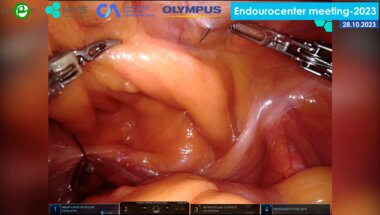 Сафиуллин Р.И. - Робот-ассистированная радикальная простатэктомия (техника с сохранением ретциева пространства da Vinci Xi)