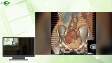 Каганцов И.М., Дубров В.И., Пелих К.И., Филиппов Д.В., Гурович А.О. - Реконструкция при критическом дефиците мочеточника единственной тазовой кости