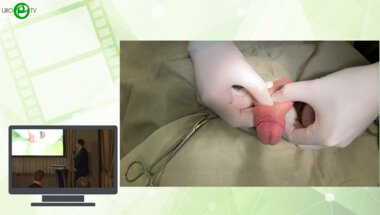 Кызласов П.С., Мустафаев А.Т., Абуев Г.Г., Боков А.И. - Корпоропластика у пациента с врожденным аномалиям полового члена