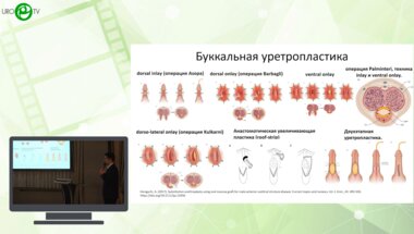 Алиев У.М., Санжаров А.Е., Прохоренко К.А., Дорончук Д.Н., Халайчев П.Б. - Буккальный графт - "универсальный" урологический материал?