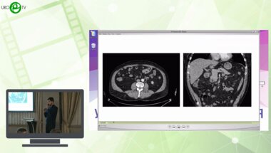 Караев Д.К., Саакян А.А., Фатихов Р.Р. - Лапароскопическая энуклеация опухоли левой почки RENAL 12 с использованием 3D-реконструкции