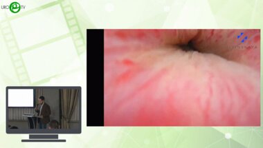 Моно П.О., Кошмелёв А.А., Баранова Е.О., Живов А.В. - Робот-ассистированная пластика стеноза уретро-везикального анастомоза